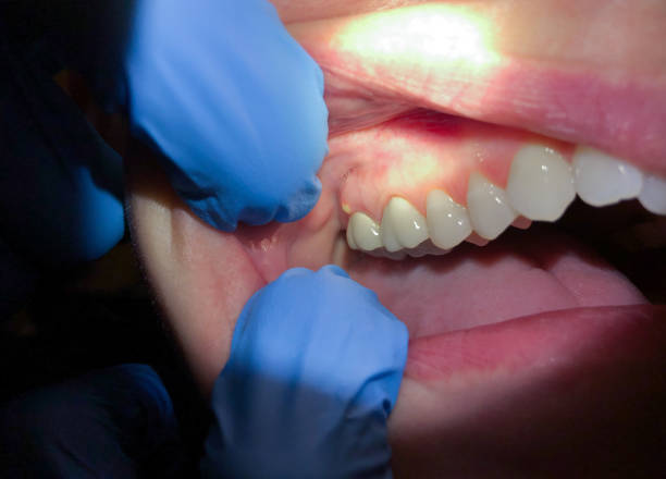 Best Emergency Treatment for Toothache in Munroe Falls, OH